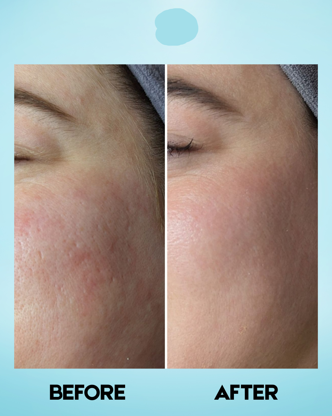 Belo Intensive Whitening Micropeeling Toner – 100 ml – Tonifiant hydratant et exfoliant – Aide à nettoyer, égaliser la teinte et à protéger la peau pour l&