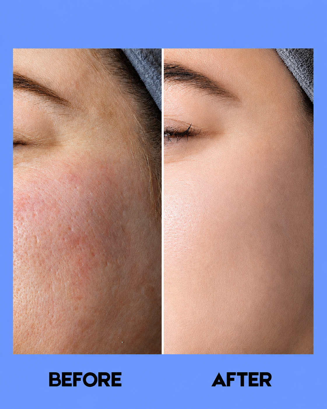 Belo Intensive Whitening Micropeeling Toner – 100 ml – Verhelderende & Exfoliërende Huidtoner – Helpt Donkere Vlekken te verminderen, Egaliseert de Huidtint & Bereidt de Huid Voor op Hydratatie – Voor een Gladde, Stralende & Gezonde Teint