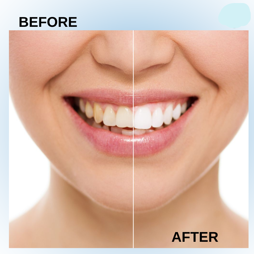 Crest 3D White Brilliance Deep Stain Remover – Groot formaat – Nieuw in Nederland – Verwijdert Diepe Tanden Vlekken, Verheldert Tanden & Beschermt Tandglazuur – Voor een Stralende, Witte & Gezonde Glimlach