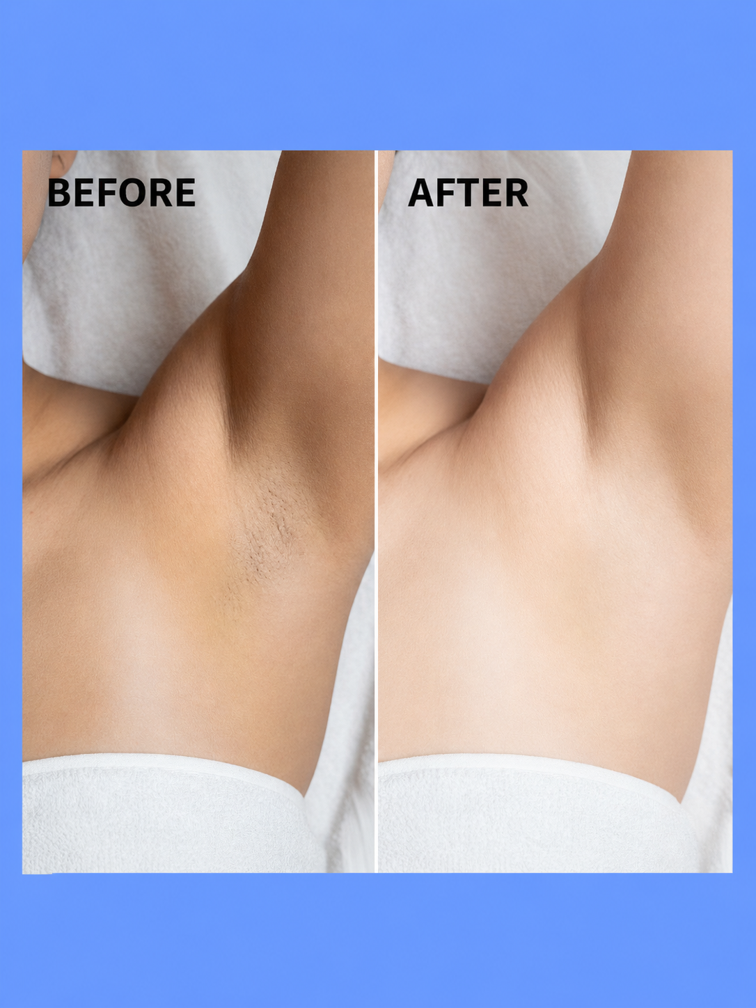 Belo Underarm Advantage Package – Ensemble d&