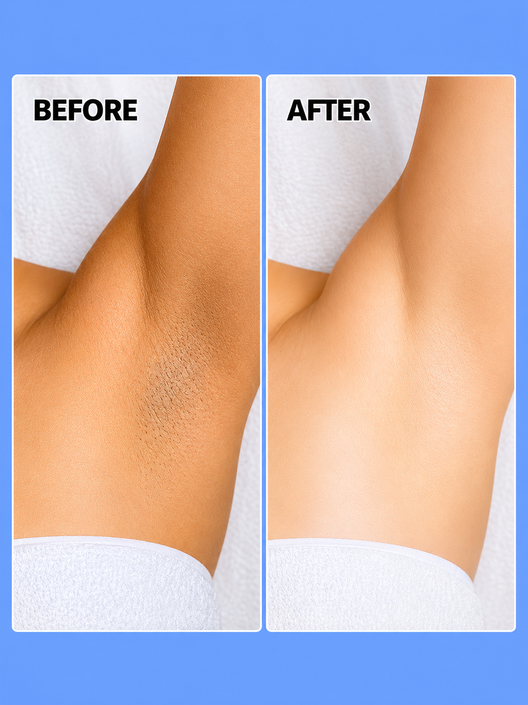 Belo Underarm Whitening Cream – 10 g – Verhelderende &amp; Verzachtende Okselcrème – Helpt Donkere Vlekken te Verminderen, Egaliseert de Huidtint &amp; Hydrateert – Voor Zachte, Stralende &amp; Gezonde Okselhuid